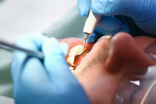 Best Emergency Tooth Extraction in Scott City, KS